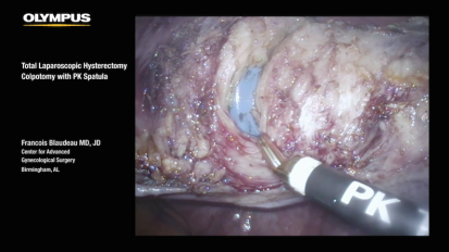 LESS TLH Colpotomy with PK Spatula