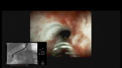 Assessing a Bile Duct Stricture Using the SpyGlass DS System, by Sri Komanduri, MD