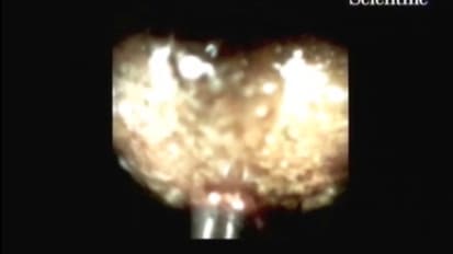 Electrohydraulic Lithotripsy for Large Common Bile Duct Stones, by Douglas G. Adler, M.D.