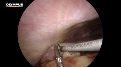 Liver Wedge Resection