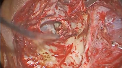Use of IMAGE1 S in Treating Cochlear Infection