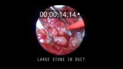 Removal of a Large Stone in a Duct