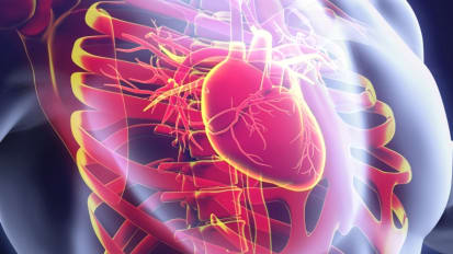 Severe calcific mitral valve stenosis