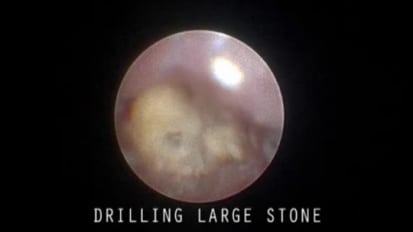 Treatment of a Large Stone with Basket and Forceps