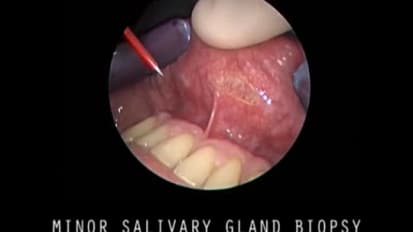 Minor Salivary Gland Biopsy