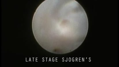 Late-Stage Sjogren’s