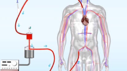 AngioVac Procedure: Treatment for Deep Venous Thrombosis