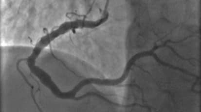 Limitations of the Coronary Angiogram: More than Meets the Eye – Cardiology Grand Rounds