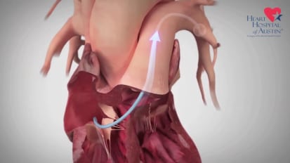 CardioMEMS: Treating Heart Failure Before the Onset of Symptoms