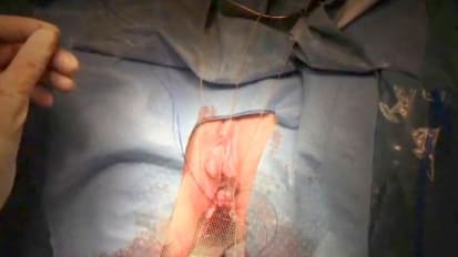 Restorelle® DirectFix Anterior and Posterior Mesh with Stat Tack™ for Pelvic Floor Repair