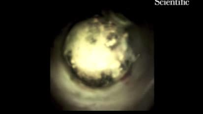 Large Common Hepatic Duct Stone Fragmented Using SpyGlass™ DS System with Holmium Laser, by Isaac Raijman, MD