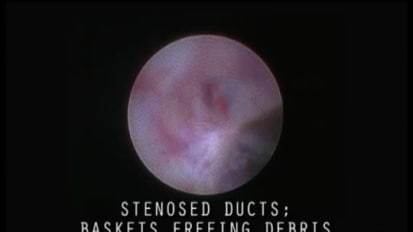 Removing a Web-Like Stenosis
