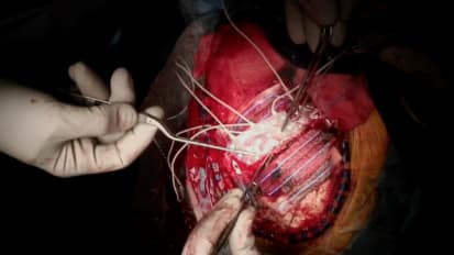 Surgical Epilepsy: Placement of Subdural Electrode Arrays and Cortical Topectomy
