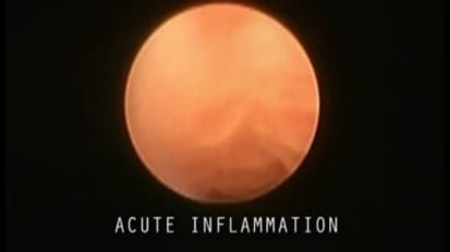 Acute Inflammation of the Salivary Ducts