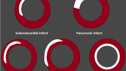 Coronary Microvascular Function and Diastolic Heart Failure in Women – Cardiology Grand Rounds