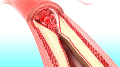 Updated Risk Assessment Guidelines for Cardiovascular Disease – Cardiology Grand Rounds