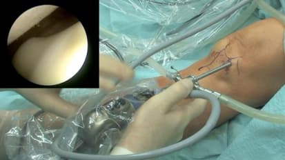 Knee Arthroscopy Prep and Portal Placement