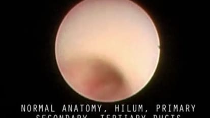 Dr. Gillespie Outlines the Goals of Diagnostic Salivary Endoscopy