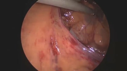 Using IMAGE1 S for Hemicolectomy