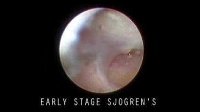 Early-Stage Sjogren’s