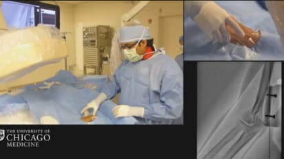 Transradial approach for cardiac catheterization: The new frontier of coronary intervention