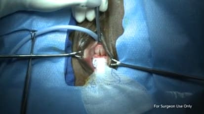 Altis® Implant for Patient with Previous Repair - Manish Patel, MD