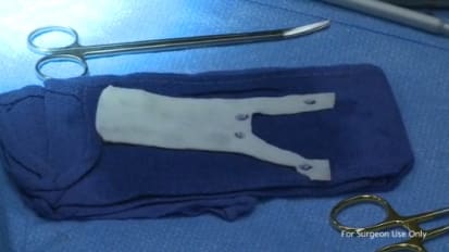 Rectocele Repair Using Axis® Tutoplast® Processed Dermis and Digitex® - Manish Patel, MD