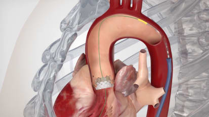 Transcatheter Aortic Valve Replacement (TAVR): Overview