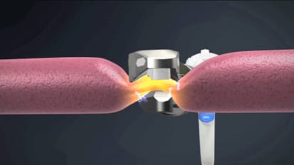 Minimizing Instrument Exchange in Hysterectomy: LSH with THUNDERBEAT 
