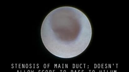 Stenosis of the Main Duct, Blocking Scope Passage