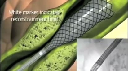 Procedural Animation: WallFlex Biliary RX Stent