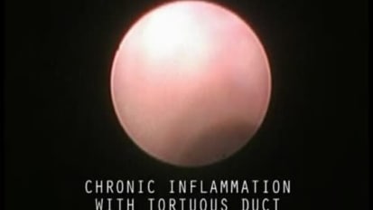 Chronic Inflammation Within a Tortuous Duct