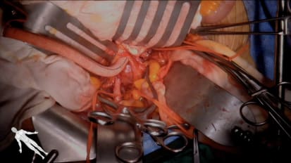 Aortic Aneurysm Surgery