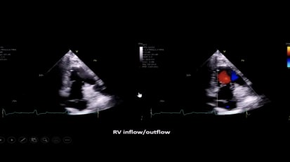 EchoHeart Summit Doppler