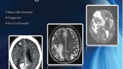 Stereotactic Radiosurgery (SRS) at John Muir Health TRUE Radiosurgery