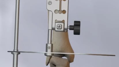 PROPHECY™ INFINITY™ Total Ankle System Surgical Technique ...