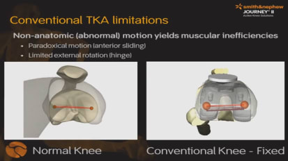 smith & nephew journey knee recall