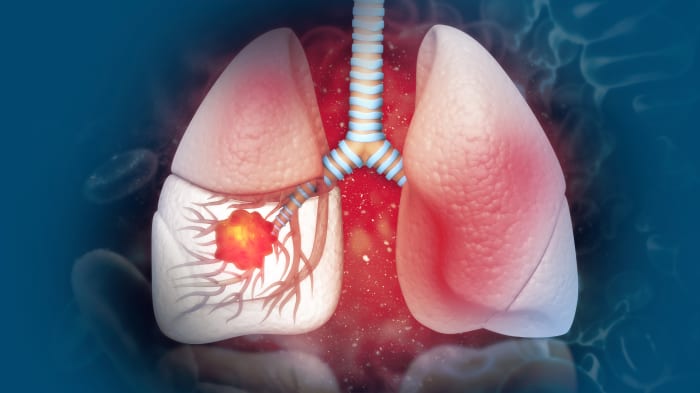 New Therapies for Lung Cancer