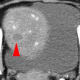 Evidence of disease activity detected in circulating tumor DNA (ctDNA) predicts radiographic melanoma progression. Credit: Johns Hopkins Kimmel Cancer Center