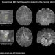 Images show novel brain MRI techniques for detecting the Central Vein Sign. Image by Cedars-Sinai.