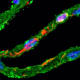 Image shows degenerated vascular cells (pericytes, in green) with accumulation of vascular amyloid-beta (in red) in the retina of an Alzheimer’s disease patient. Image by Cedars-Sinai.