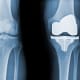 Before and after X-rays of a total knee replacement