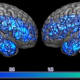 A brain showing decreases of serotonin transporters (blue) in the whole mild cognitive impairment group compared to the whole healthy control group.