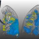 Low-opacity (blue) and high-opacity (yellow) lesions.