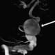 An angiogram 3D reconstruction showing the patient's a giant vertebral fusiform aneurysm (arrow).