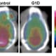 Positron emission tomography (PET) images of mouse brains in the study show decreased brain glucose with GLUT1 (G1D) deficiency relative to normal (control). The color scale at right indicates the amount of glucose present, increasing up the scale.