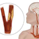 TCAR expands treatment options for carotid artery disease. Illustration courtesy of Silk Road Medical.