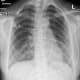 Chest X-ray image of patient with lung injury due to vaping.