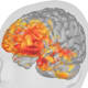 A 3-D rendering shows a 15-year-old male football player's brain. He experienced a helmet-to-helmet collision in a tackling drill and was clinically diagnosed with a concussion, and he received MEG and MRI scans within 72 hours of the injury. The red and yellow area represents increased delta waves in his post-concussion scan, where the darkest red represents the greatest increase.