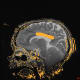 MRI with heat map overlay shows laser ablation of the main body of the corpus callosum. Credit: Angela V. Price, M.D.